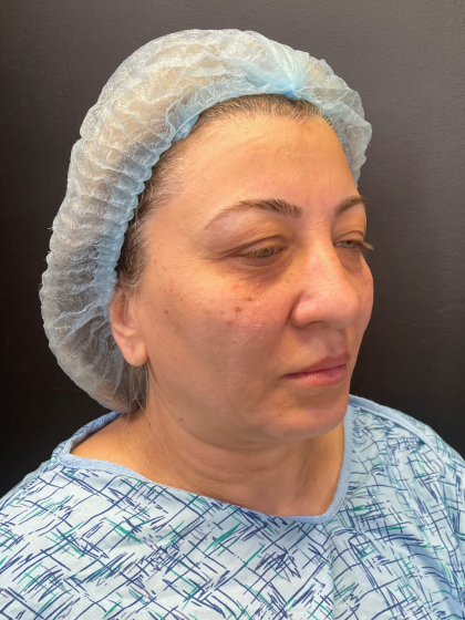Brow Lift and Blepharoplasty (Eyelid Surgery) Before & After Patient #11687