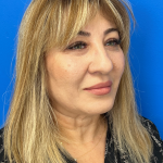 Brow Lift and Blepharoplasty (Eyelid Surgery) Before & After Patient #11687