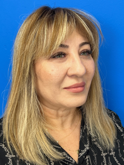Brow Lift and Blepharoplasty (Eyelid Surgery) Before & After Patient #11687