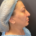 Brow Lift and Blepharoplasty (Eyelid Surgery) Before & After Patient #11687