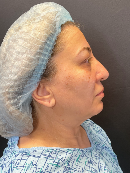 Brow Lift and Blepharoplasty (Eyelid Surgery) Before & After Patient #11687