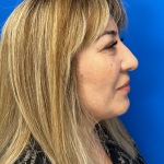 Brow Lift and Blepharoplasty (Eyelid Surgery) Before & After Patient #11687