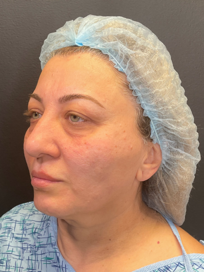 Brow Lift and Blepharoplasty (Eyelid Surgery) Before & After Patient #11687