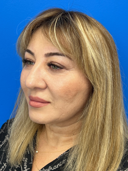 Brow Lift and Blepharoplasty (Eyelid Surgery) Before & After Patient #11687