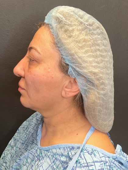 Brow Lift and Blepharoplasty (Eyelid Surgery) Before & After Patient #11687