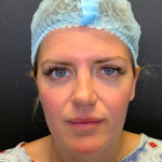 Fat transfer to Face Before & After Patient #11801