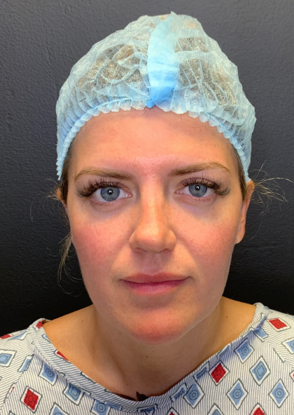 Fat transfer to Face Before & After Patient #11801