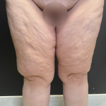 Thigh Lift Before & After Patient #11838
