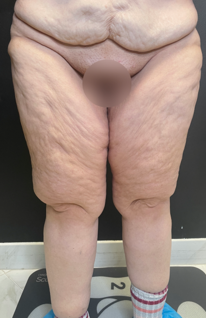 Thigh Lift Before & After Patient #11838