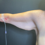 Arm Lift Before & After Patient #11837