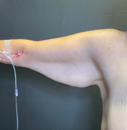 Arm Lift Before & After Patient #11837