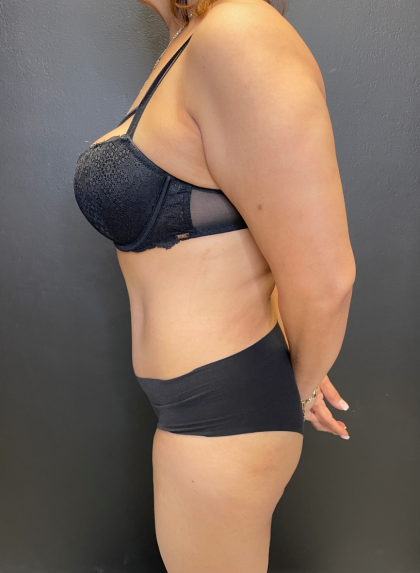 Tummy Tuck Before & After Patient #11788