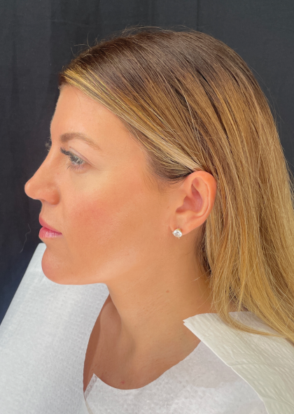 Fat transfer to Face Before & After Patient #11801