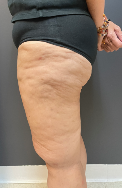 Thigh Lift Before & After Patient #11838