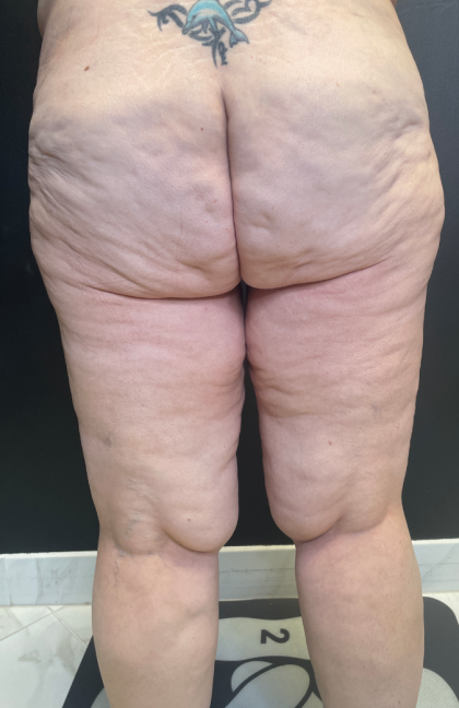 Thigh Lift Before & After Patient #11838