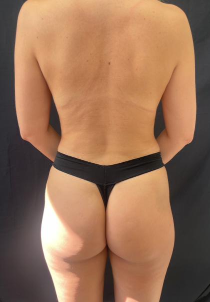 Liposuction Before & After Patient #11800