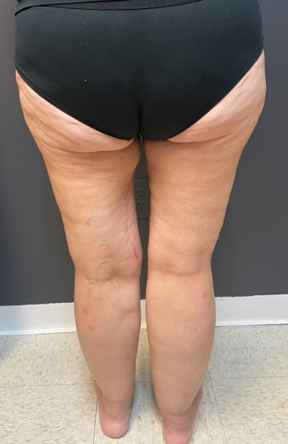 Thigh Lift Before & After Patient #11838
