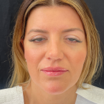 Fat transfer to Face Before & After Patient #11801