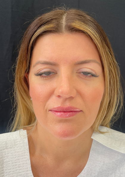 Fat transfer to Face Before & After Patient #11801