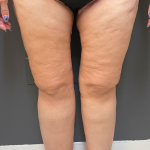 Thigh Lift Before & After Patient #11838