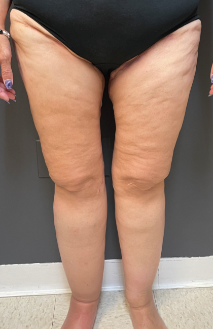 Thigh Lift Before & After Patient #11838