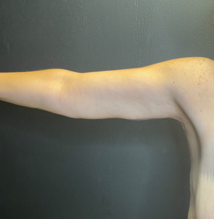 Arm Lift Before & After Patient #11837