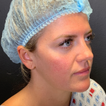 Fat transfer to Face Before & After Patient #11801