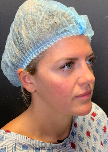 Fat transfer to Face Before & After Patient #11801