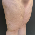 Thigh Lift Before & After Patient #11838