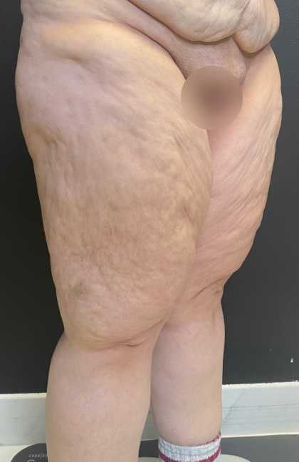 Thigh Lift Before & After Patient #11838