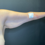 Arm Lift Before & After Patient #11837