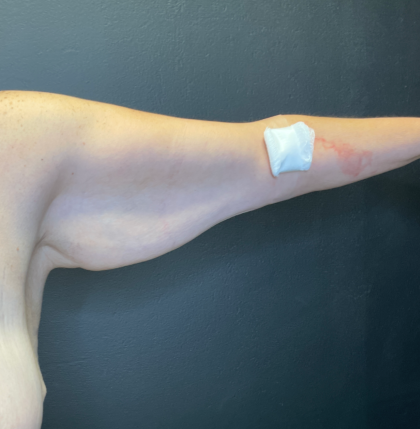 Arm Lift Before & After Patient #11837