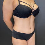Tummy Tuck Before & After Patient #11788
