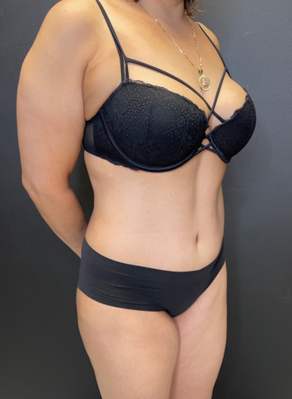 Tummy Tuck Before & After Patient #11788
