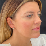 Fat transfer to Face Before & After Patient #11801