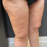 Thigh Lift Before & After Patient #11838