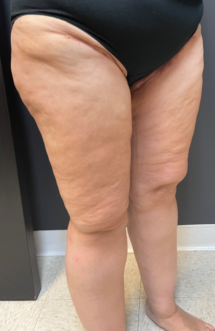 Thigh Lift Before & After Patient #11838