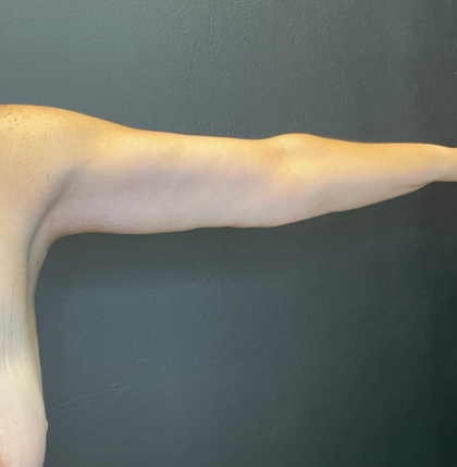 Arm Lift Before & After Patient #11837