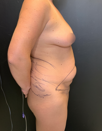 Tummy Tuck Before & After Patient #11776