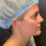 Fat transfer to Face Before & After Patient #11801