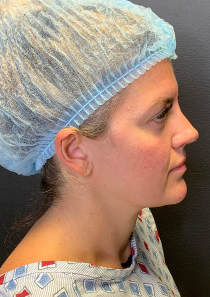 Fat transfer to Face Before & After Patient #11801