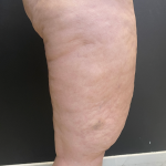 Thigh Lift Before & After Patient #11838