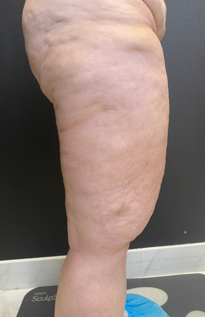 Thigh Lift Before & After Patient #11838