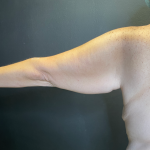 Arm Lift Before & After Patient #11837