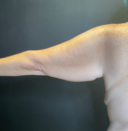 Arm Lift Before & After Patient #11837