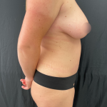 Tummy Tuck Before & After Patient #11776