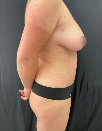 Tummy Tuck Before & After Patient #11776