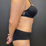 Tummy Tuck Before & After Patient #11788