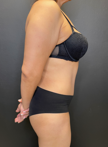 Tummy Tuck Before & After Patient #11788