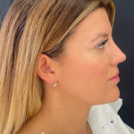 Fat transfer to Face Before & After Patient #11801